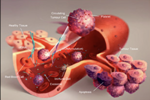 CTC (血中遊離がん細胞)検査では、がん転移とがん幹細胞が分かる